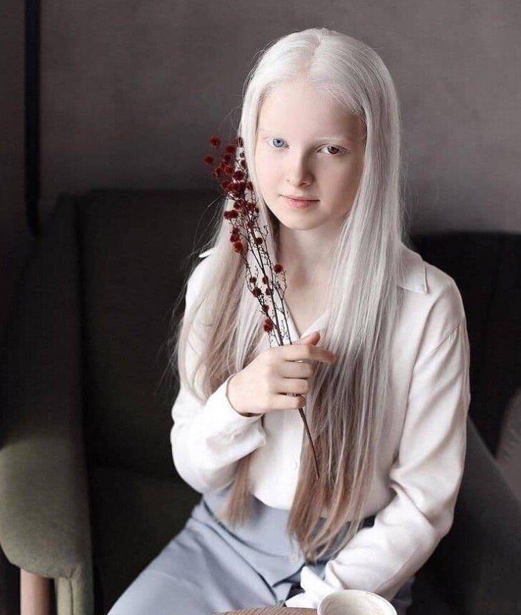 Русалочка: 11-летняя девочка с альбинизмом и гетерохромией (разным цветом глаз)