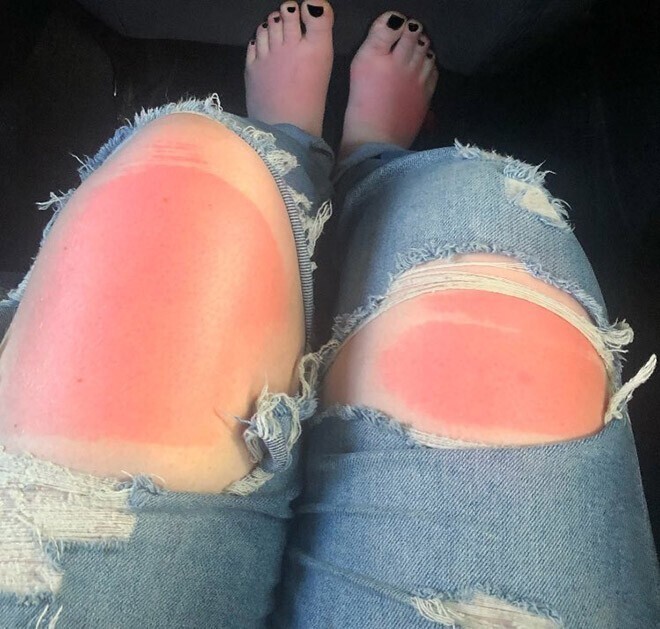 Рваные джинсы опасны в жару