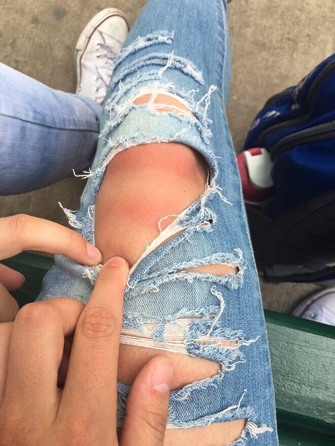 Рваные джинсы опасны в жару