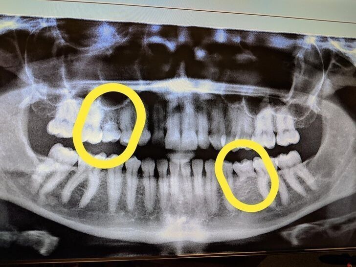 14. "Зубная фея должна мне много денег. Мне 33 года, и вот мои рентгеновские снимки, на которых видны оставшиеся молочные зубы"