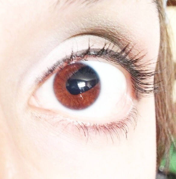 Это глаз моей подруги. У неё заболевание "Колобома"