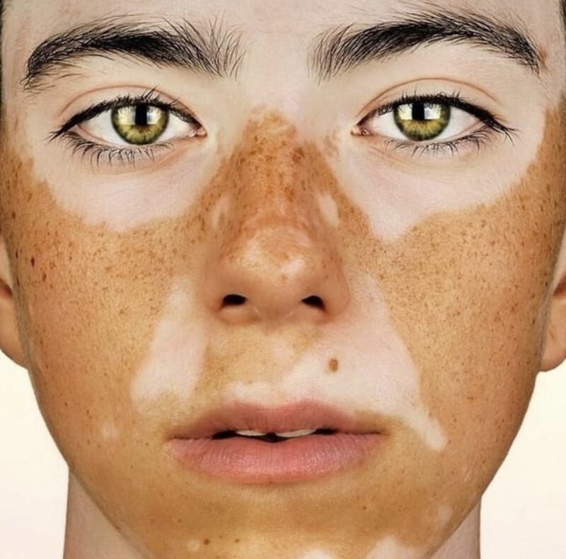 Пигментация кожи на лице фото