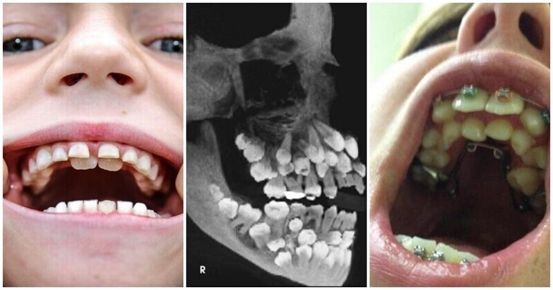 Пугающие факты о человеческом теле: как возникает аномалия зубов