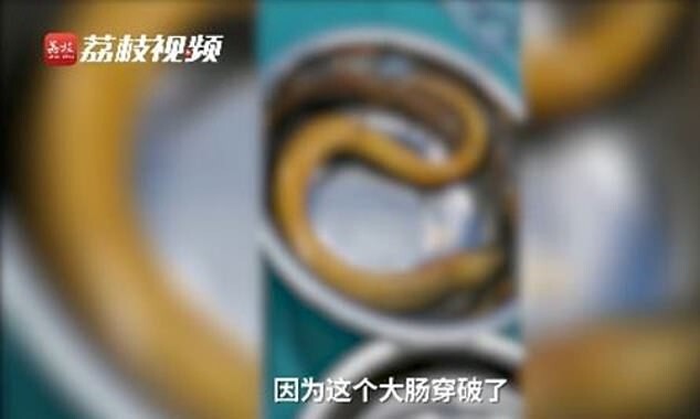 Китаец попытался вылечить запор, вставив в прямую кишку 20-сантиметрового угря