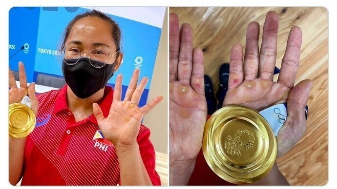 Руки штангистки Хиделин Диаз - первой золотой медалистки филиппинской сборной. По словам Диаз, это пустяки - травм, которые не видны, у нее гораздо больше