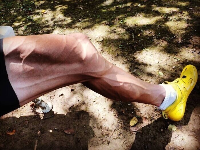 Ноги олимпийского легкоатлета после окончания сезона подготовки к Играм