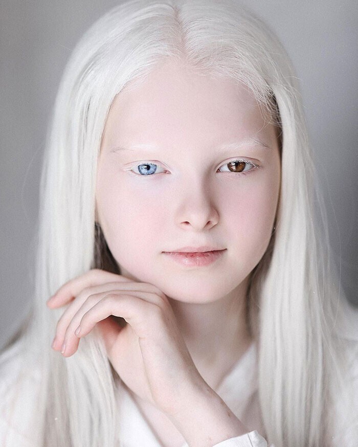 Амина Эпиндиева - обладательница двух редких генетических нарушений: у нее гетерохромия и альбинизм. Они делают ее похожей на фею