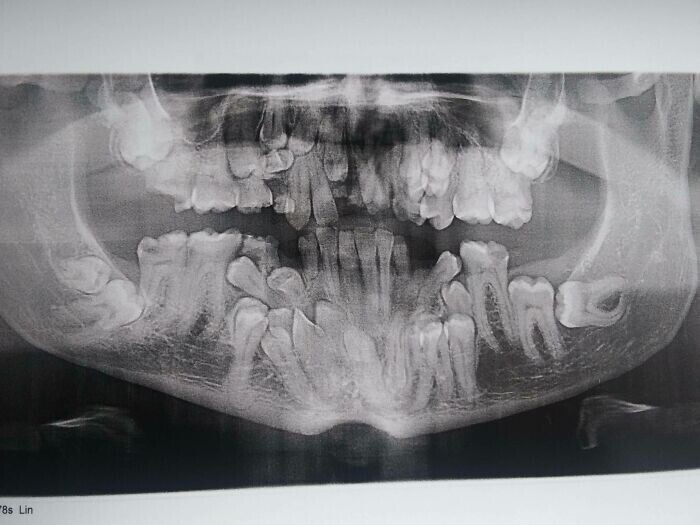 "Сегодня я впервые сделал рентген обеих челюстей. Оказывается, у меня полон  рот сверхкомплектных хубов!
