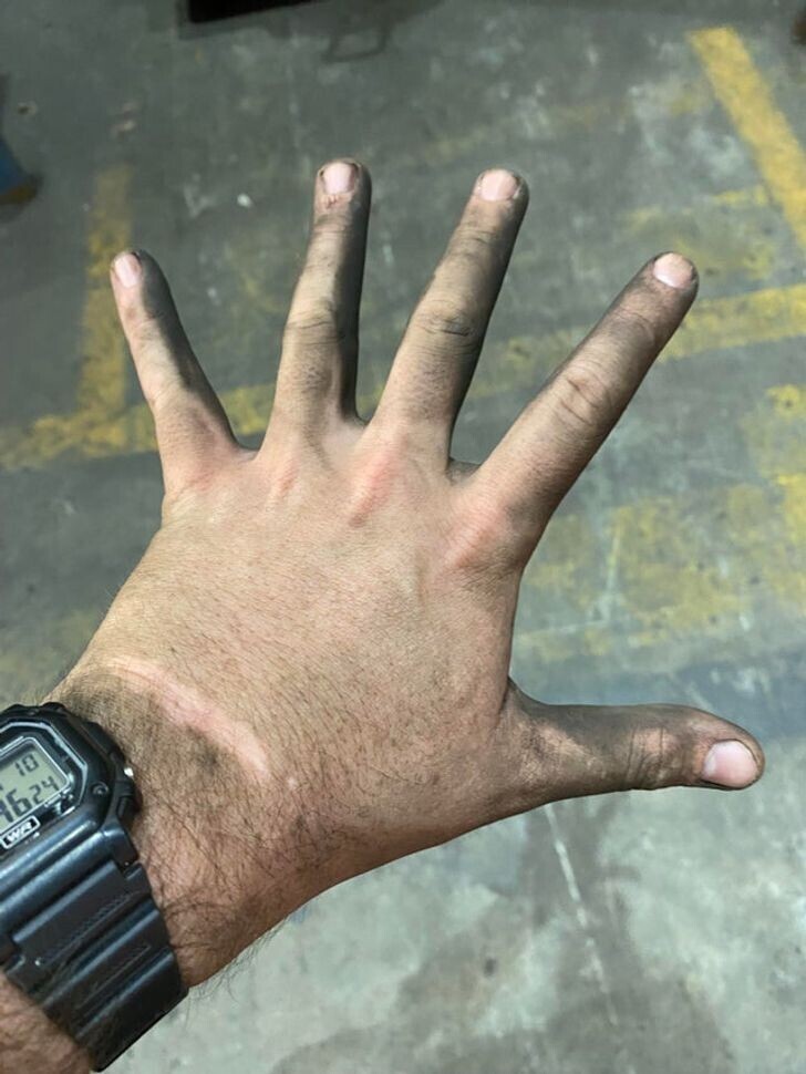 "После дня работы на сталелитейном заводе. Пыль покрыла всю мою руку, кроме шрама"