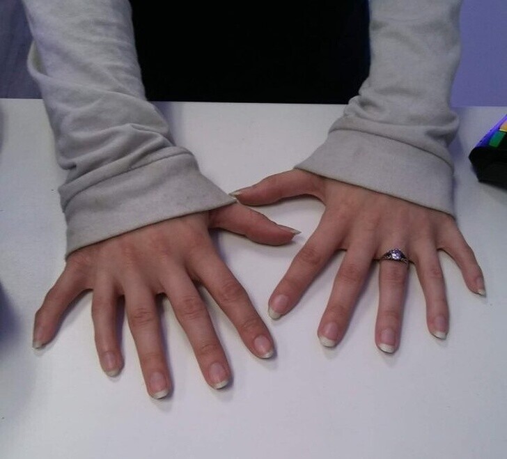 Такая полидактилия: человек с шестью пальцами на каждой руке