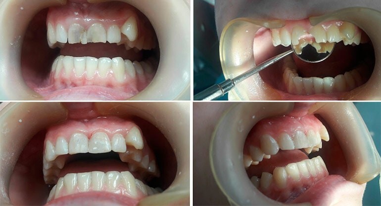  Как ставят пломбу на зуб  