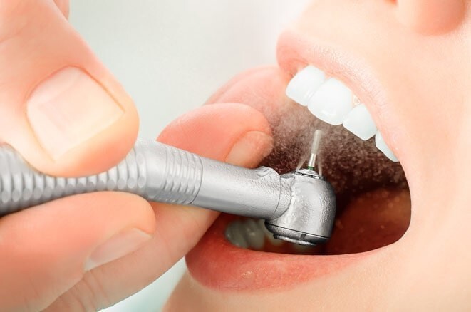  Как ставят пломбу на зуб  