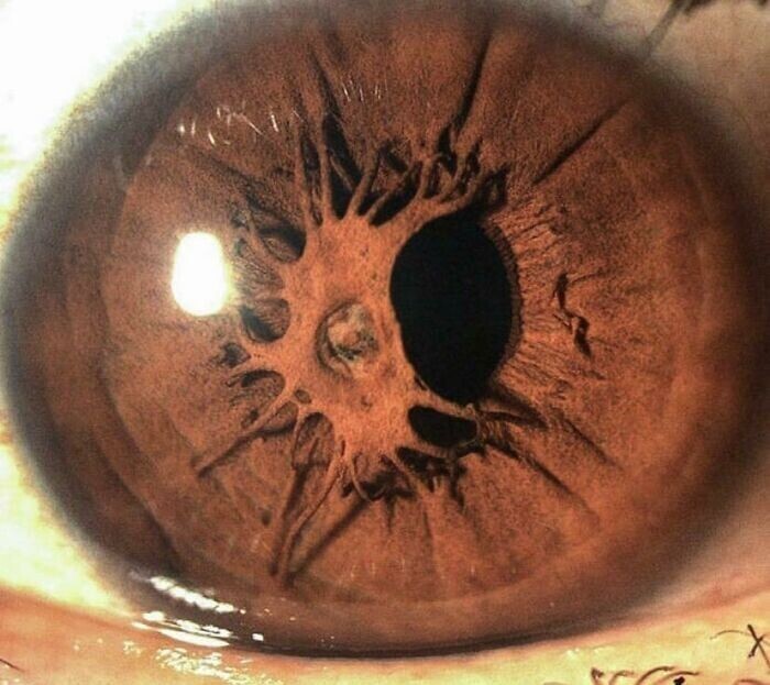 31. Остаточная мембрана зрачка - состояние глаза с остатками эмбриональной мембраны, которые остаются как нити, пересекающие зрачок