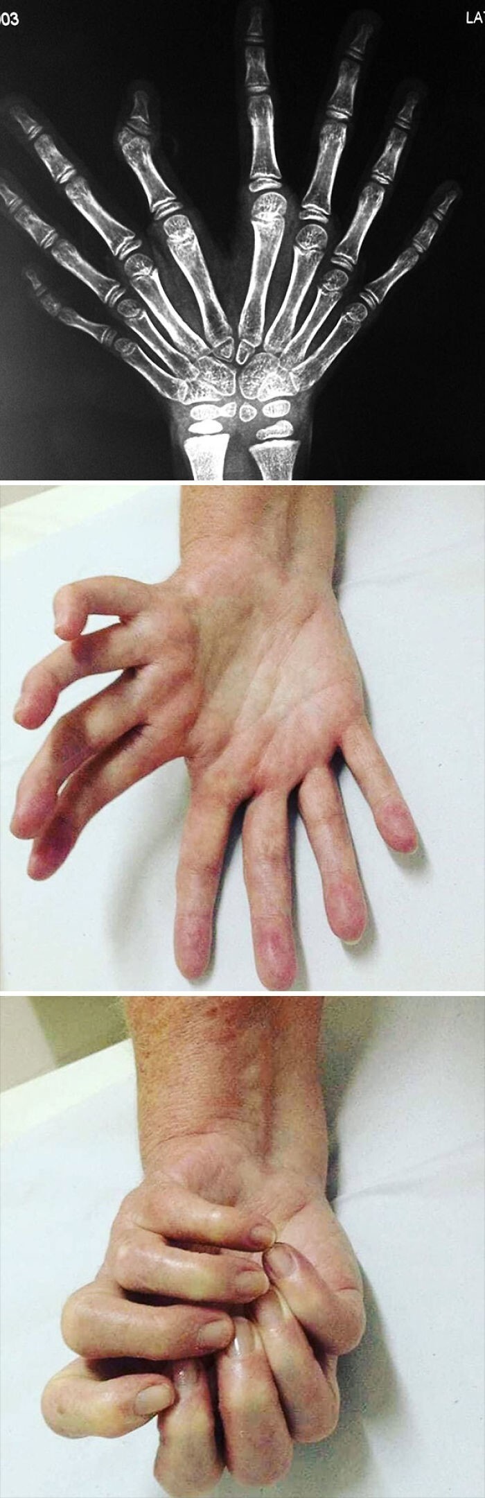 Ульнарная димелия или синдром зеркальной руки