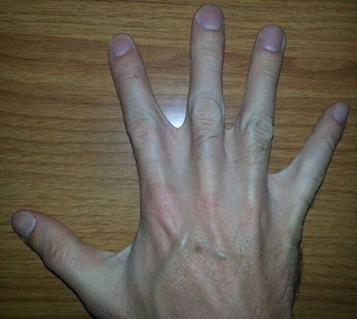 Перепонки между пальцами - очень редкий атавизм