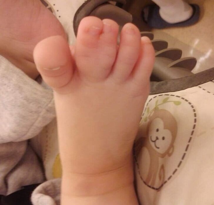 Каждый год в мире рождается от 2000 до 3000 детей со сросшимися пальцами на ногах