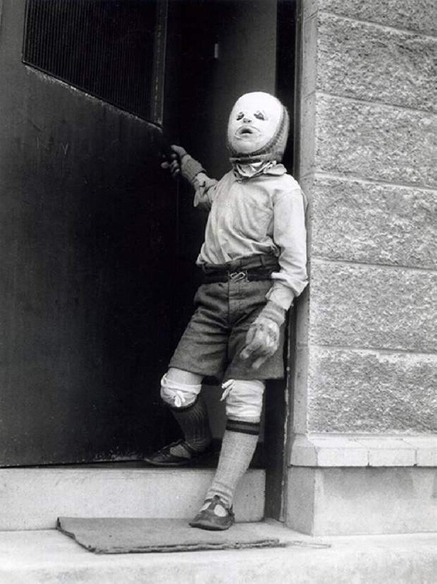 8-летний шотландец Фредди Макинтош в костюме для защиты от солнца. Кожа мальчика очень чувствительна к дневному свету из-за болезни. 1961 год.