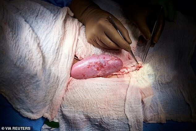 Хирурги успешно пересадили человеку почки свиньи