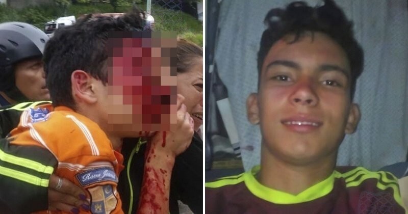 Подросток потерял оба глаза после того, как полиция выстрелила ему в лицо во время акции протеста
