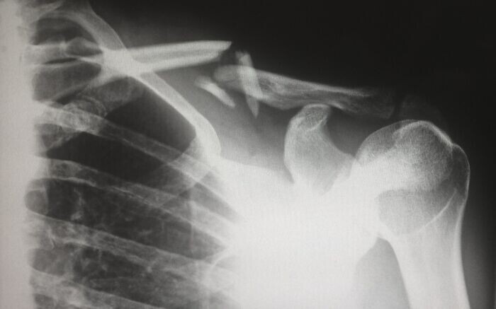 13. Когда рентгеновские технологии впервые стали широко доступны педиатрам, они заметили поразительно большое количество сломанных костей. Озадаченные врачи предположили, что ранее неизвестное заболевание костей у детей