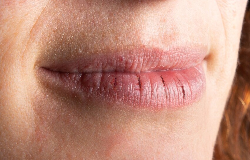 Почему губы шелушатся, сохнут и покрываются трещинками?