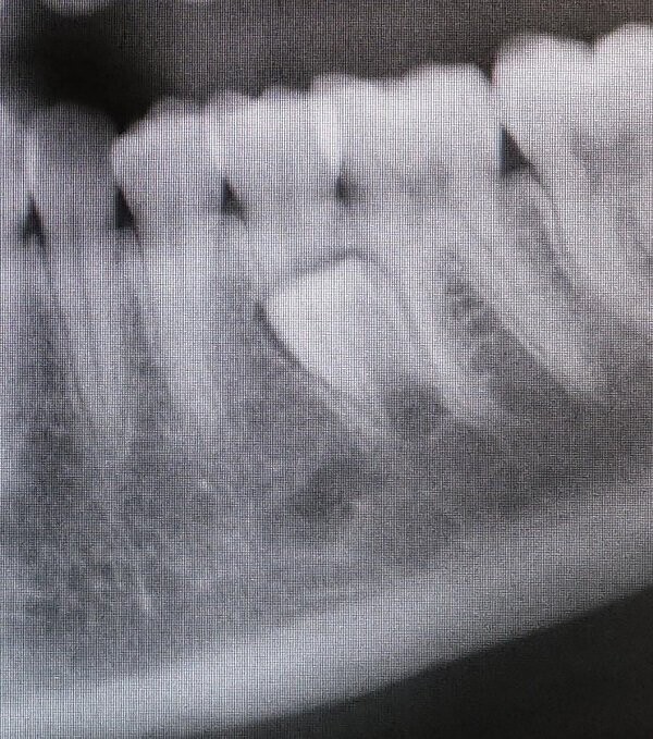"У меня давно выросли постоянные зубы, но, как выяснил сегодня стоматолог, у меня есть один запасной"
