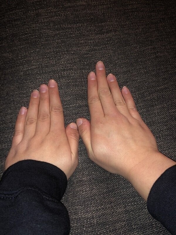 У этой девушки пальцы на разных руках имеют разную длину