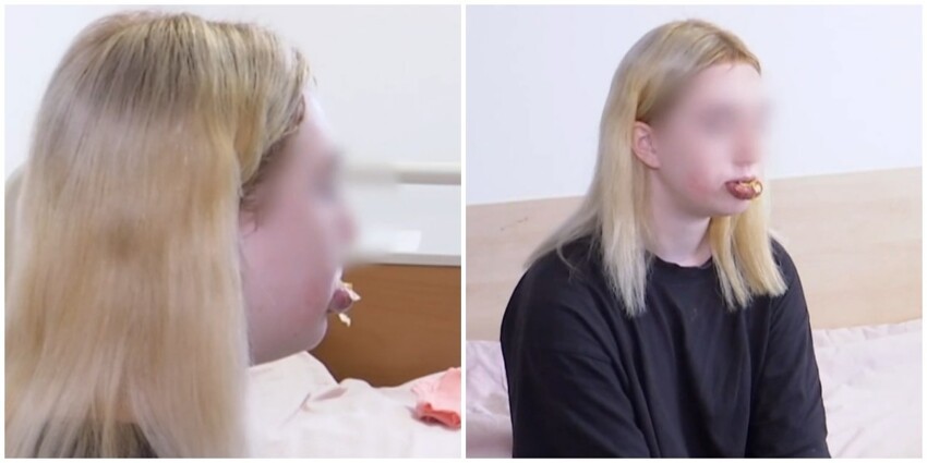 Лайфхак из интернета: 14-летняя девочка решила увеличить губы и сама вколола себе косметическое масло