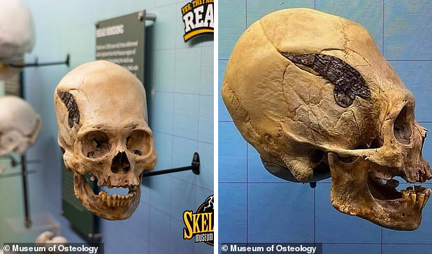 Металлическую пластину в голове перуанского воина назвали древнейшей операцией на черепе