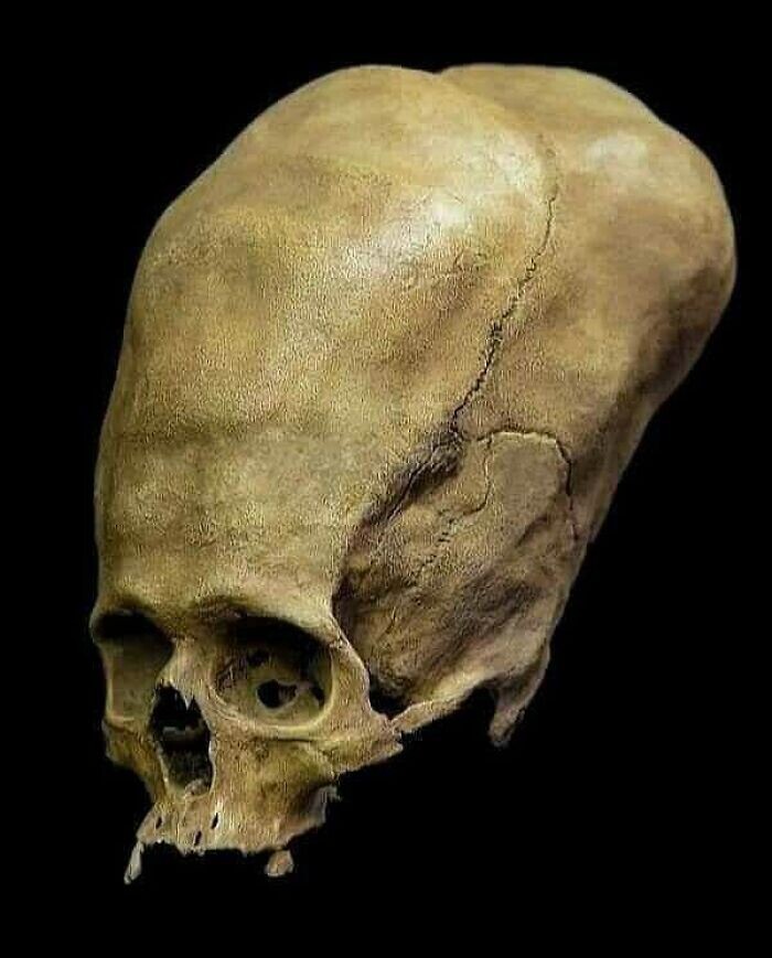 25. Тайна удлиненных черепов Паракаса. В 1920-х годах перуанский археолог Хулио Тельо обнаружил несколько гробниц в Паракасе, Перу, в которых были вот такие черепа