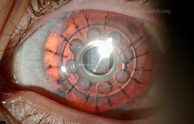 Искусственная роговица, имплантированная в глаз пациента