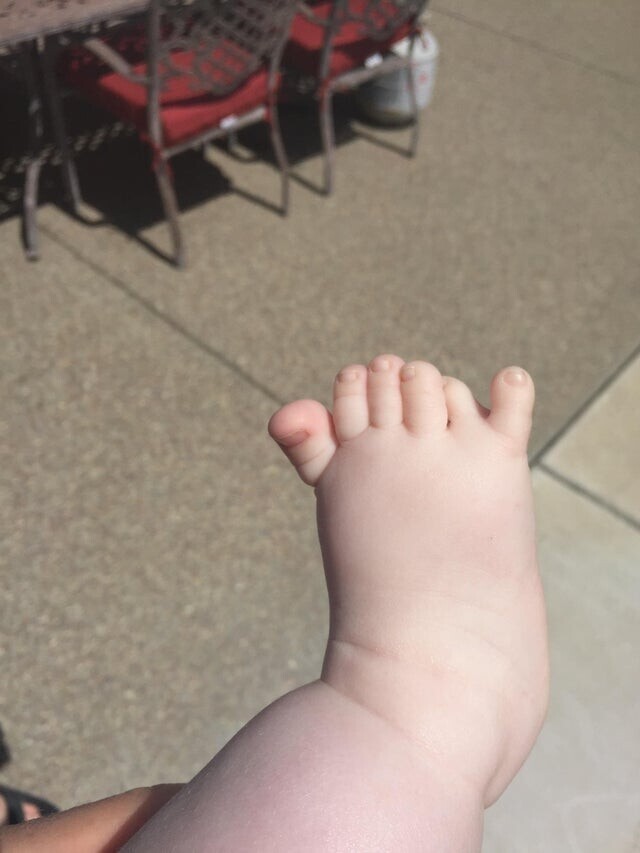 Мой племянник родился с шестью пальцами на ногах