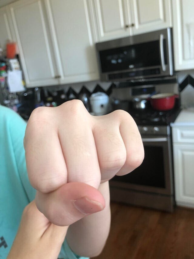 У моей сестры отсутствует сустав. Ее палец работает, но он просто короткий