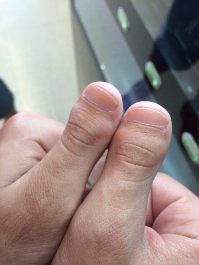 Мои пальцы на руках выглядят как пальцы на ногах