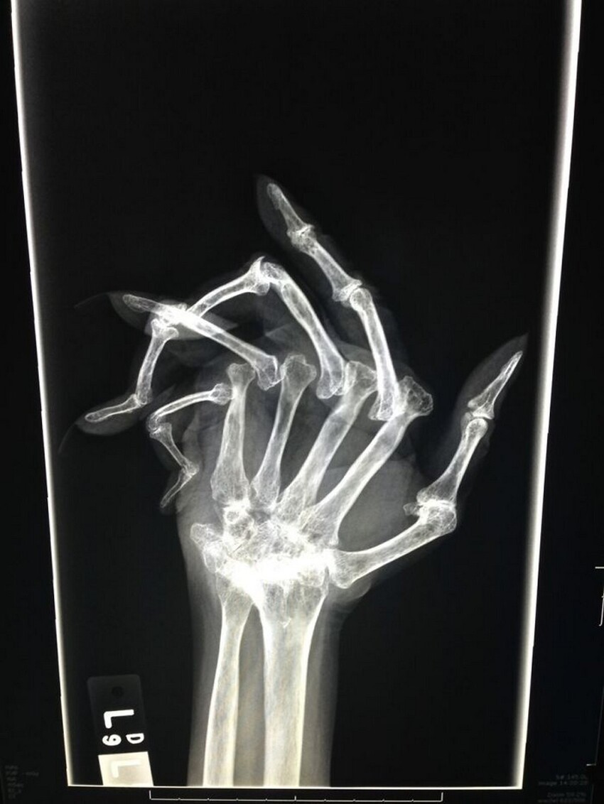 Тяжелый случай ревматоидного артрита на рентгене