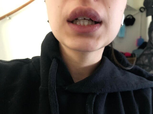 Моя девушка открывала зубами бутылку с водой, и у неё отвалился кусок зуба