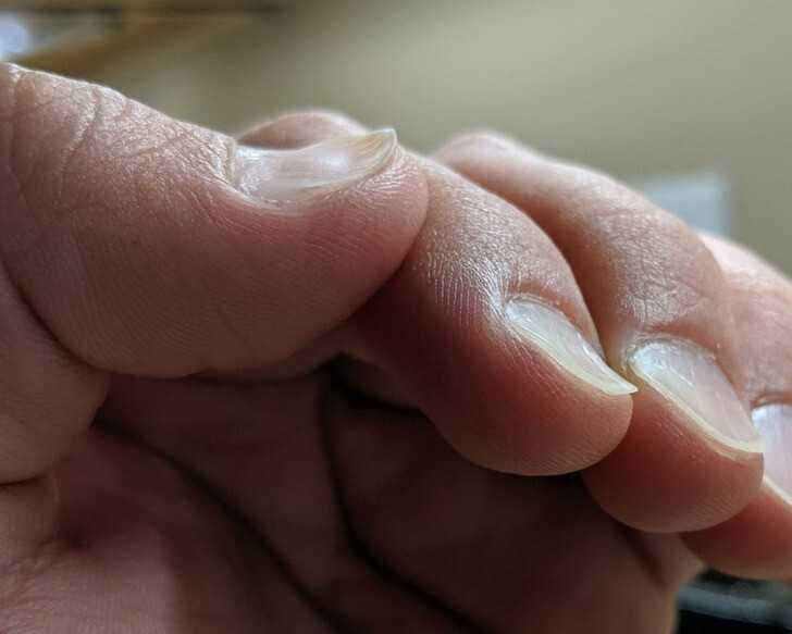 15. "У моего мужа редкая генетическая мутация, из-за которой ногти растут вывернутыми наизнанку"