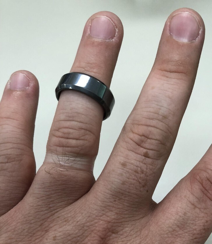 2. "Как мое обручальное кольцо деформировало мой палец за почти 7 лет"