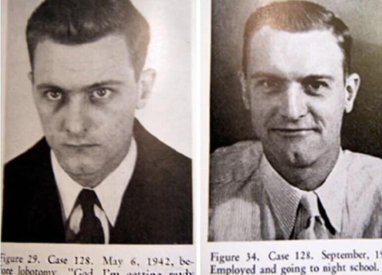 Снимки мужчины с шизофренией до и после лоботомии