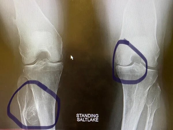 18. «Я обратился к ортопеду по поводу колена, и тот обнаружил гигантскую опухоль в моей ноге (мне также нужно заменить коленный сустав на другой ноге до конца года)».