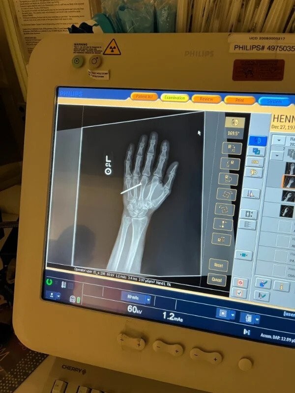 1. «Рентгеновский снимок гвоздя в моей руке».