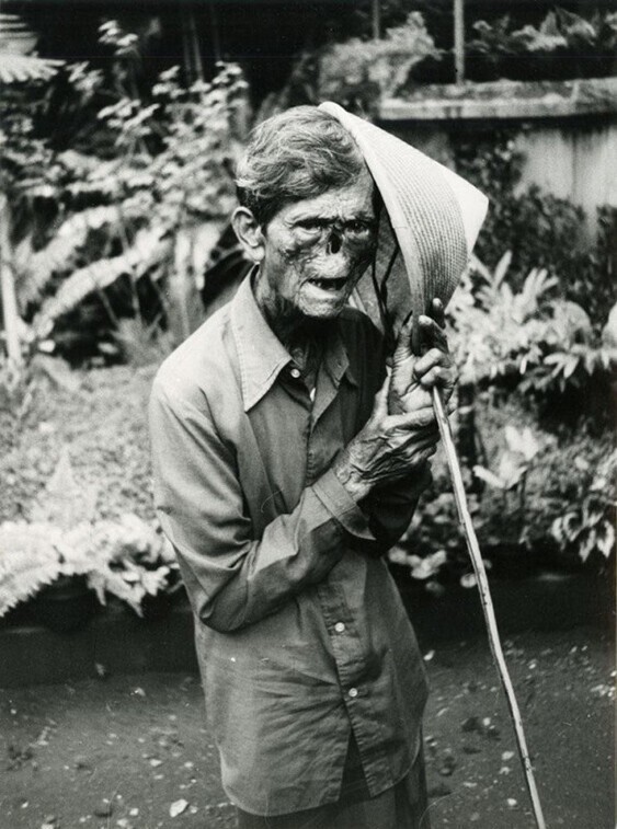 Индонезийский мужчина, страдающий проказой. 1984 год