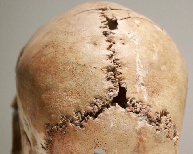Череп 25-летней женщины, перенесшей операцию на головном мозге 9500 лет назад. Сейчас он находится в Музее Аксарая, Турция
