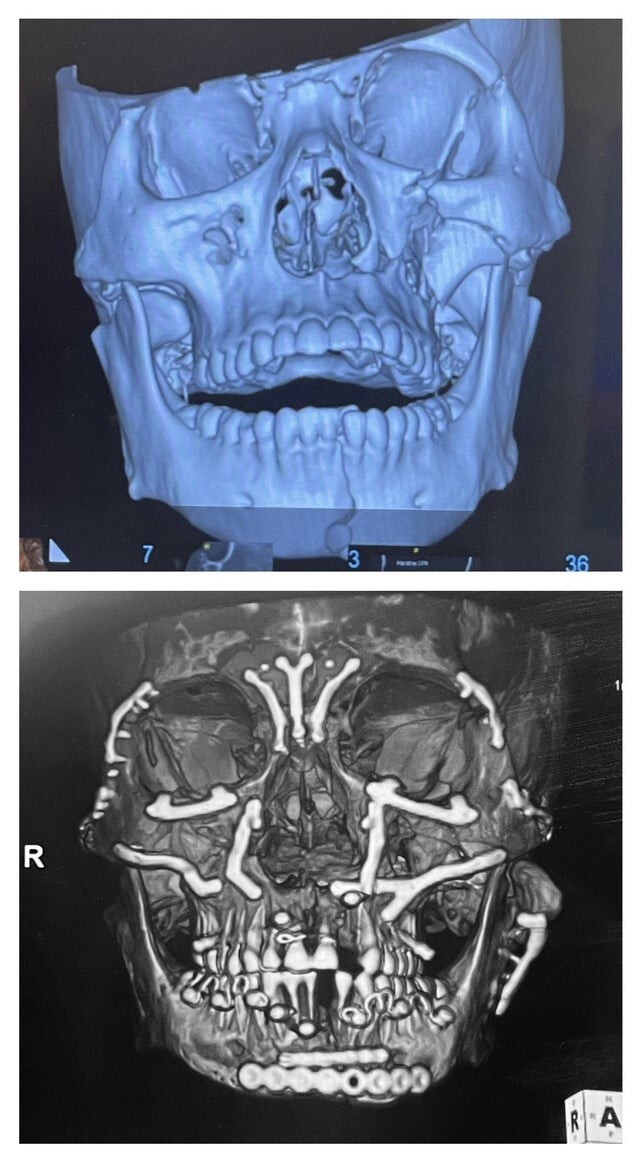 "4 месяца назад я сломал все кости на лице: 90 винтов и 30 пластин спустя я на пути к выздоровлению"