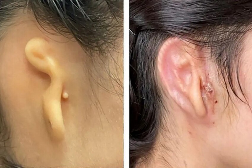 Медики из США впервые пересадили пациентке ухо, напечатанное на 3D-принтере
