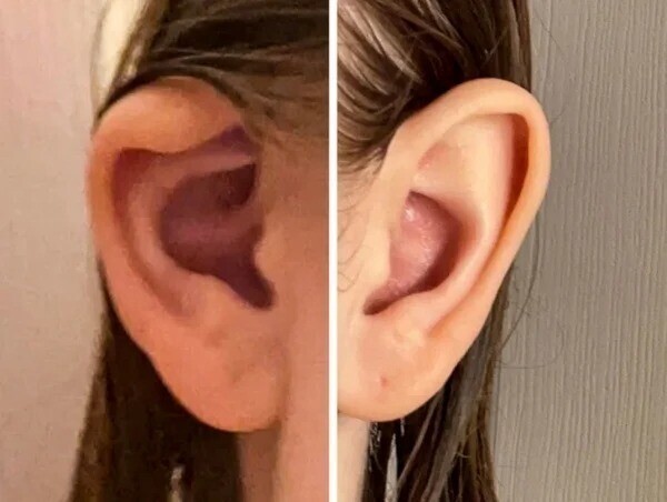"Мои уши - абсолютно разные по форме"