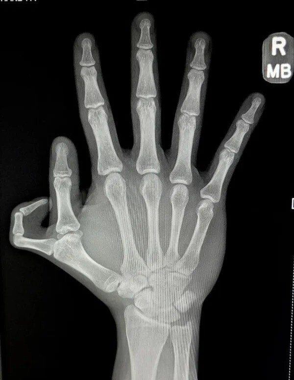Рентгеновский снимок кисти с шестью пальцами