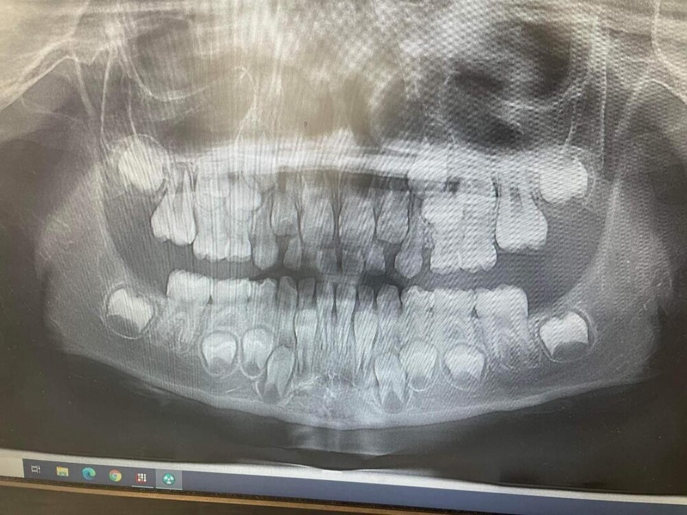 Рентген детских зубов с молочных фото