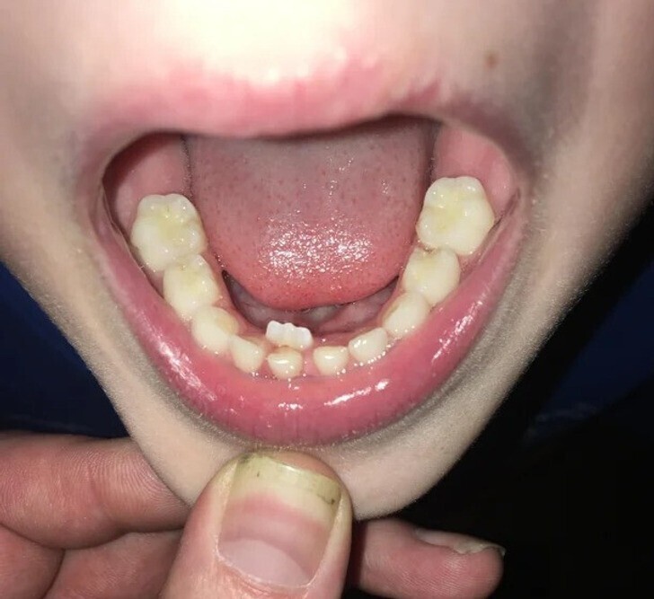 4. «У моего ребёнка постоянный зуб растет позади молочного. Ему 6 лет. У него до сих не выпал ни один зуб»