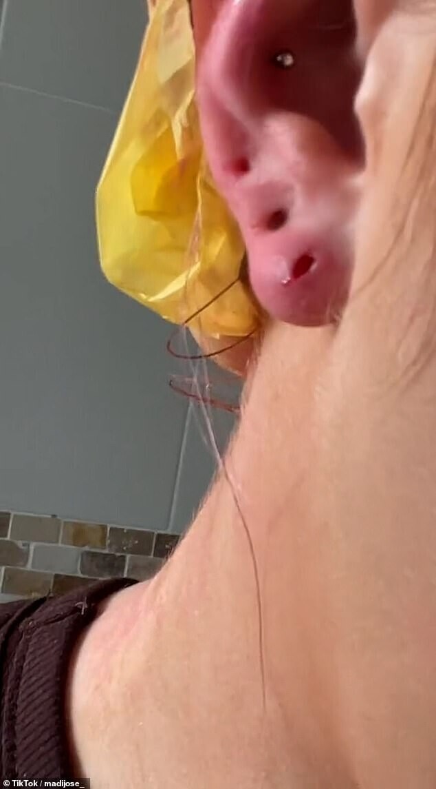 Женщина потеряла часть уха из-за дешевых сережек